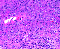 Monomorphic Post-transplant Lymphoproliferative Disorder H&E