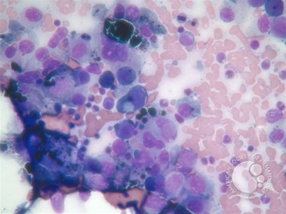 Malignant melanoma with the bone marrow carcinomatosis - 2.