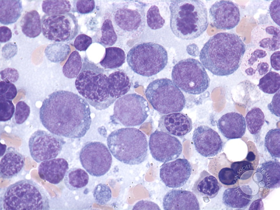 Acute erythroid leukemia - 3.