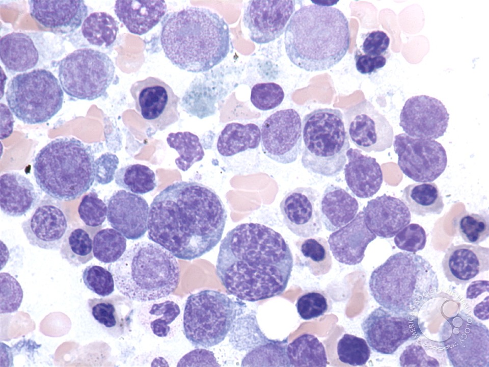 Acute erythroid leukemia - 4.
