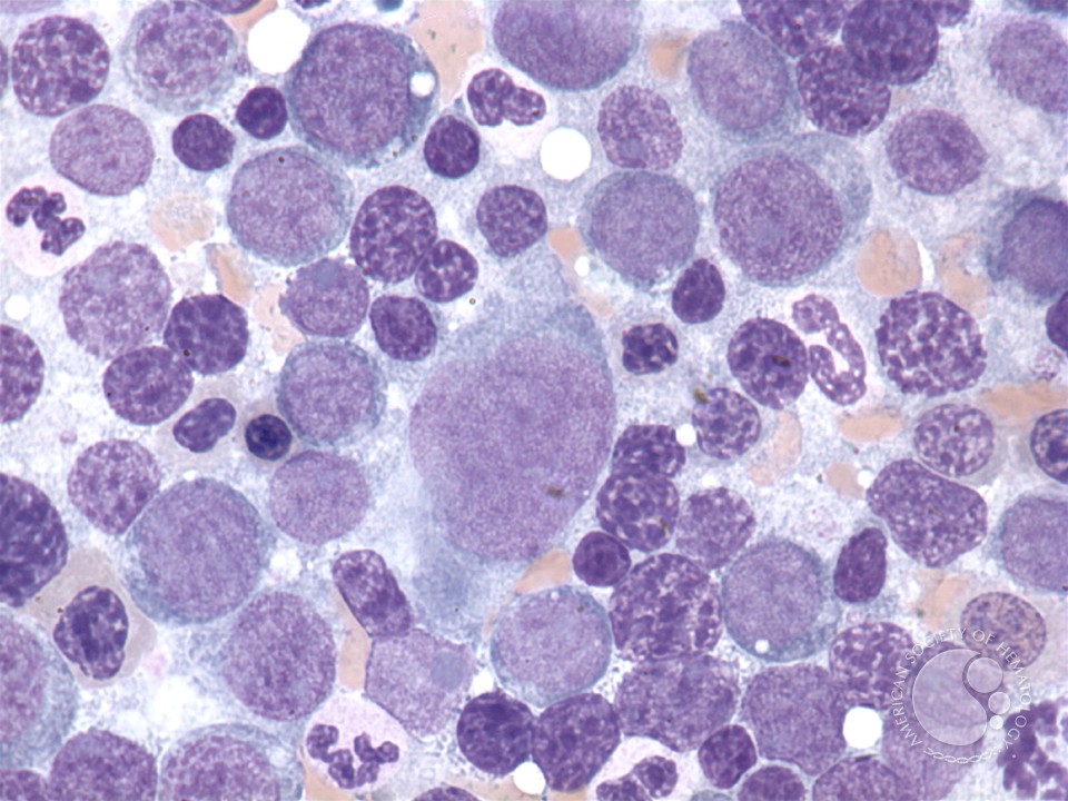 Acute erythroid leukemia - 5.