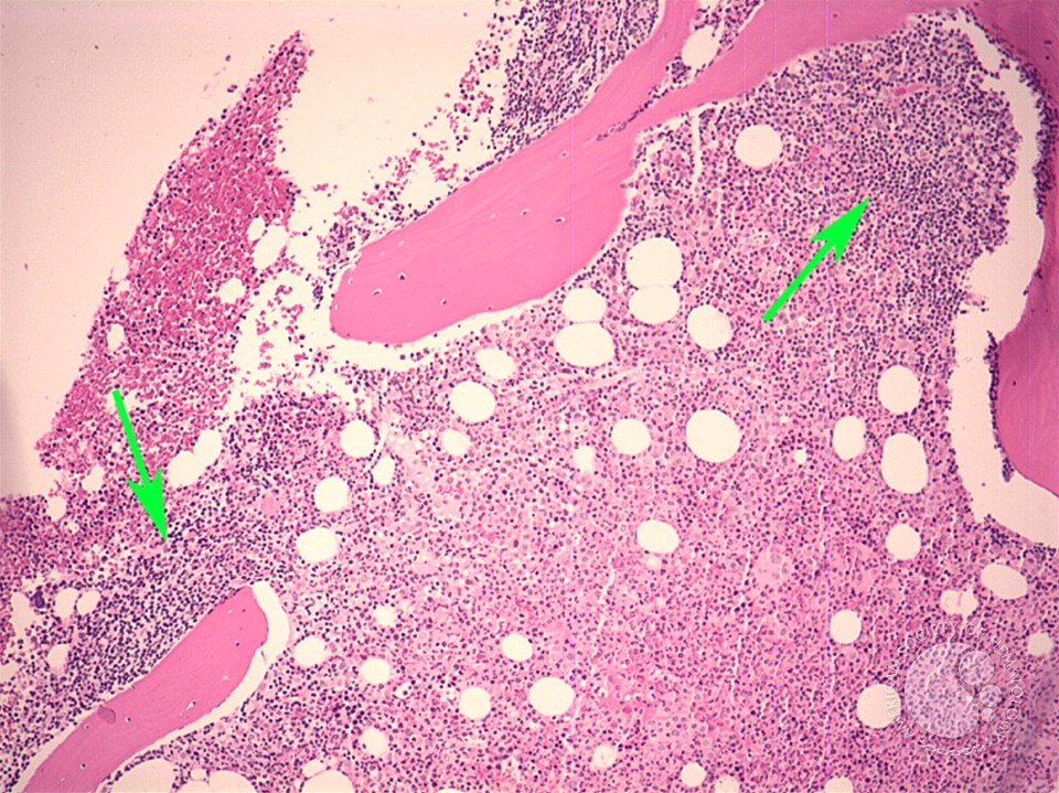 Follicular lymphoma-bone marrow biopsy - 1.