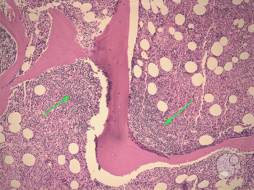 Follicular lymphoma-bone marrow biopsy - 2.