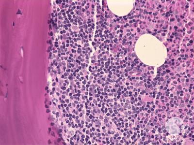 Follicular lymphoma-bone marrow biopsy - 3.
