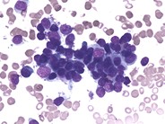 pdf-how-i-treat-hemophagocytic-lymphohistiocytosis-in-the-adult