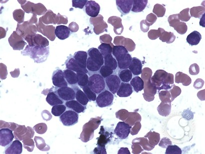 Hemophagocytic lymphohistiocytosis – reactive - 3.
