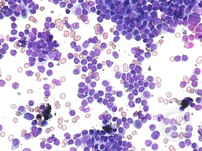 Hemophagocytic lymphohistiocytosis – reactive - 4.