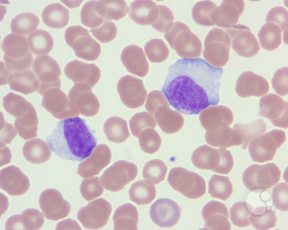 Infectious mononucleosis - 2.