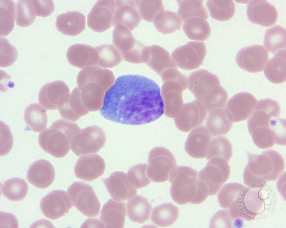 Infectious mononucleosis - 4.