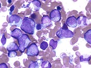 Left shifted myelopoiesis with toxic granulation - 1.