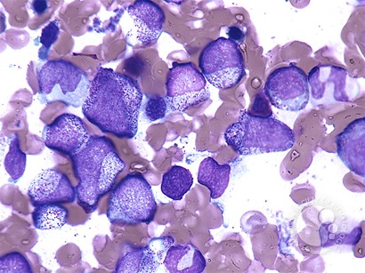 Left shifted myelopoiesis with toxic granulation - 1.
