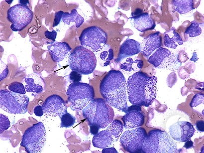 Left shifted myelopoiesis with toxic granulation - 2.