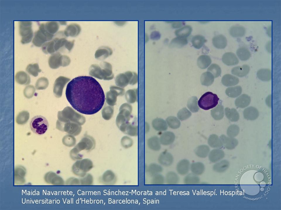 Erythroblasts with typical morphology of Parvovirus B19 infection