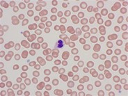 Peripheral blood findings in juvenile myelomonocytic leukemia - 1.