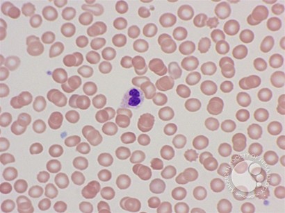 Peripheral blood findings in juvenile myelomonocytic leukemia - 1.
