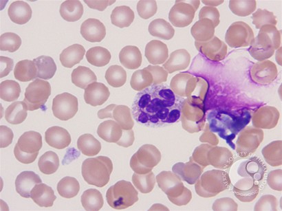 Peripheral blood findings in juvenile myelomonocytic leukemia - 2.