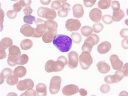 Peripheral blood findings in juvenile myelomonocytic leukemia - 4.
