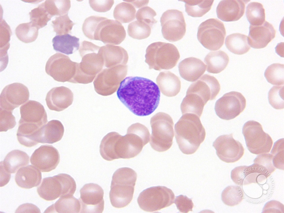 Peripheral blood findings in juvenile myelomonocytic leukemia - 4.