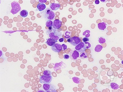 Peripheral blood findings in juvenile myelomonocytic leukemia - 5.