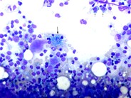 Mott cells - 2.