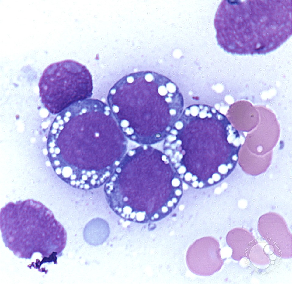 Burkitt leukemia - 2.