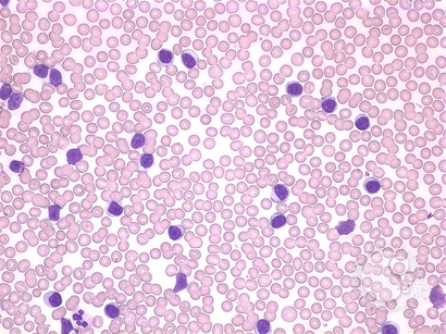 T-cell prolymphocytic leukemia - 1.