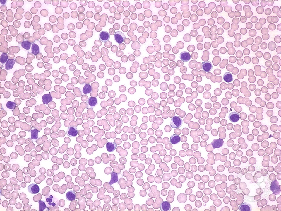 T-cell prolymphocytic leukemia - 1.