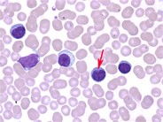 T-cell prolymphocytic leukemia - 2.