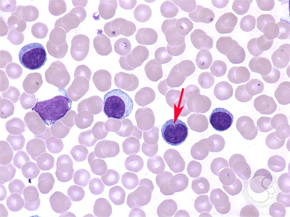 T-cell prolymphocytic leukemia - 2.