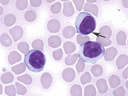 T-cell prolymphocytic leukemia - 4.