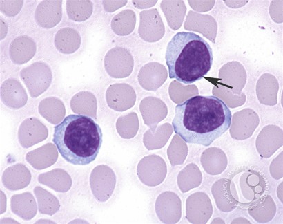 T-cell prolymphocytic leukemia - 4.