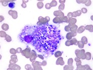 Histoplasma capsulatum in macrophage in bone marrow - 1.