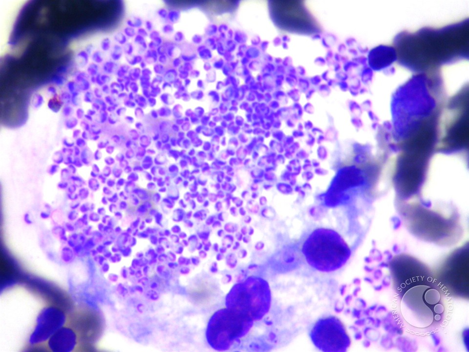 Histoplasma capsulatum in macrophage in bone marrow - 2.