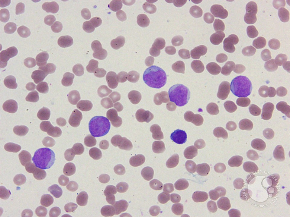 AML M7 - Acute Megakaryoblastic Leukaemia | LearnHaem 