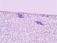 Neutrophil clumping in peripheral blood