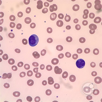 Blastic plasmacytoid dendritic cell neoplasm