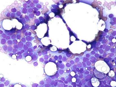 Acute monocytic leukemia - 1.