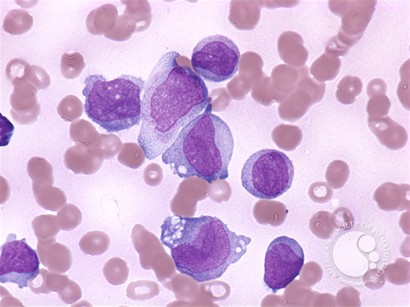 Dysplastic monocytes - 2.