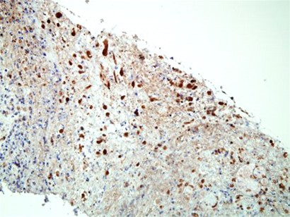 Herpes simplex lymphadenitis - 3.