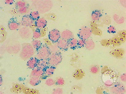 Refractory anemia with ringed sideroblasts and thrombocytosis (RARS-T) - Prussian blue iron stain - 2.