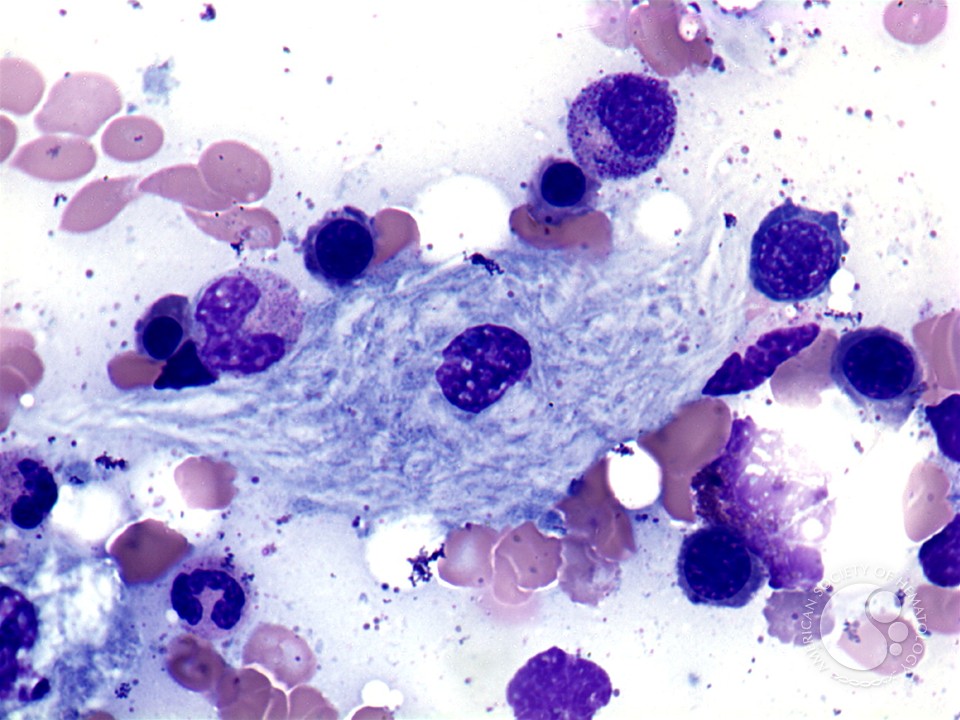 Gaucher’s disease: aspirate - 2.