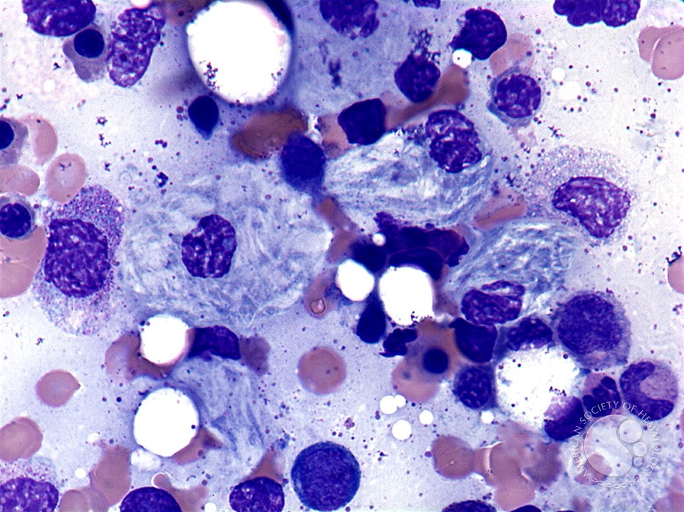 Gaucher’s disease: aspirate - 4.