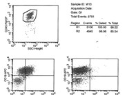 Mantle cell lymphoma - CSF