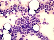 Reactive marrow - 1.