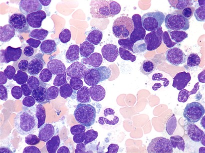 Waldenström’s macroglobulinemia: bone marrow aspirate - 2.