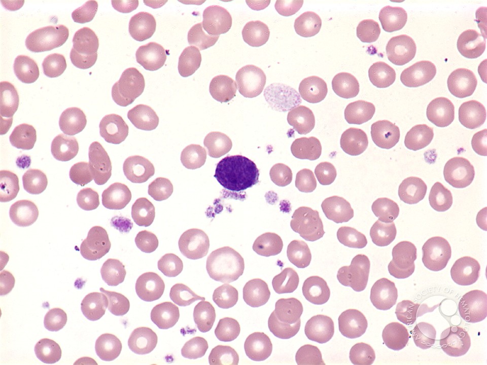 Myelofibrosis: peripheral blood - 1.