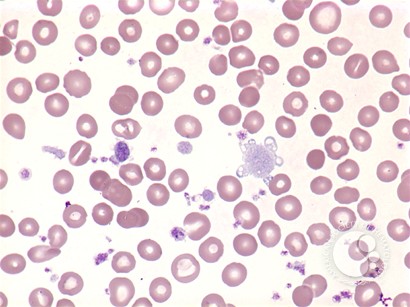 Myelofibrosis: peripheral blood - 2.