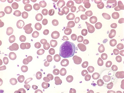 Myelofibrosis: peripheral blood - 4.