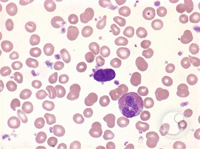 Myelofibrosis: peripheral blood - 5.