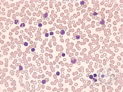 Adult T-cell leukemia /  lymphoma
